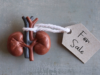 SocMed post ng pagbebenta ng kidney para sa mga concert tix, ikinabahala ng mga doktor
